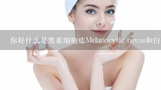 你好什么是黑素细胞痣Melanocytic